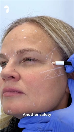 Part 2 - Sculptra Side Effects & Safety: What You Need to Know Before Treatment