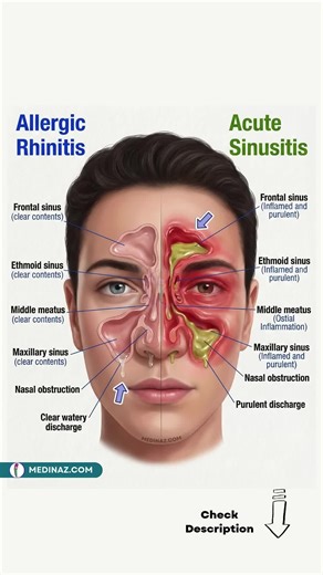 ❇️ Allergic Rhinitis vs Acute Sinusitis — Know the Difference ▶️ Allergic Rhinitis: Allergic rhinitis is an immune-mediated response to allergens such as dust, pollen, molds, or pet dander. The sinuses remain clear, but the nasal lining becomes swollen, leading to: → Clear, watery nasal discharge → Sneezing and itching → Nasal congestion from mucosal swelling → Pale, boggy nasal mucosa There is no pus, as this is not an infection. ▶️ Acute Sinusitis: Acute sinusitis occurs when the sinus drainag