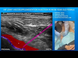Ultrasound Guided Hip Joint Injection-with an effusion in an 86 Year Old Female