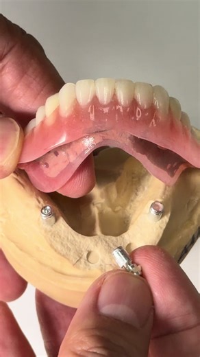 Hybrid Denture by Dr. Matthew Elbert in Ohio