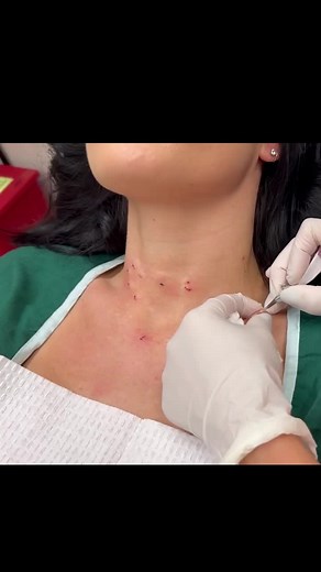 Sandra Lee, MD, FAAD, FAACS | We came across a "blue" steatocystoma - watch the full procedure at the link in bio!⁠ ⁠ This lovely patient gets recurring steatocystomas... | Instagram