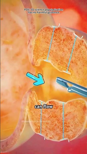 How Urolift Surgery is Performed? (3D Animation)