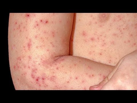 Follicular eczema, Steroid induced folliculitis, Pityrosporum folliculitis