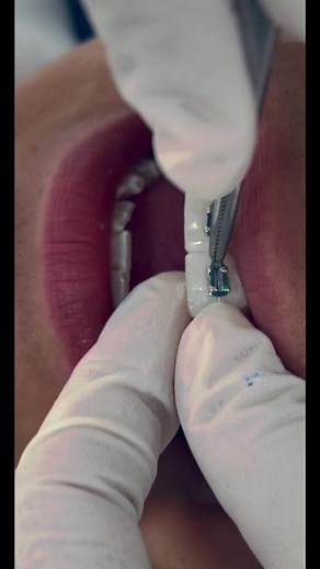 Braces Adjustment Procedure Explained