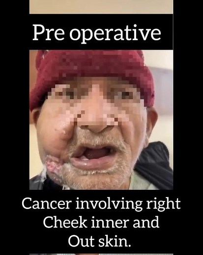 Double Paddle ALT Flap | Inner & Outer Cheek Cancer Reconstruction | Before & After