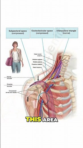 🚨 THORACIC OUTLET SYNDROME IS NOT JUST RIBS AND SCALENES 🚨