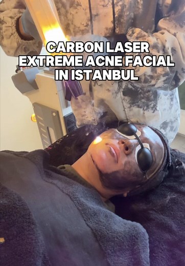 Carbon Laser Facial for Extreme Acne: My Journey