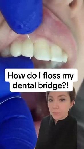 How to Floss Your Dental Bridge Effectively