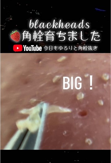 角栓抜き動画: 毛穴ケアの新常識