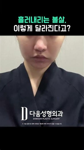 불독처럼 처진 심부볼, 턱선까지 달라 보인다고? 👀 #shorts