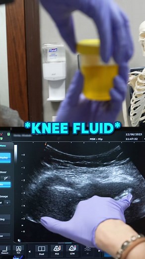 What is aspiration treatment for knee? Joint aspiration, or arthrocentesis, is a crucial medical procedure aimed at diagnosing and treating joint-related issues. 🩺💉 By using a needle and syringe, doctors can remove fluid from around a joint. This is often performed under local anesthetic to ensure comfort and ease. Why is this procedure important? 🤔 * \t\tDiagnosis: Extracting fluid helps in analyzing and diagnosing various joint disorders. * \t\tTreatment: It aids in treating conditions like