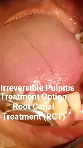 🦷SevereTooth Pain! Irreversible Pulpitis in Lower Second Molar. Dental Case Explained#thedentalguru