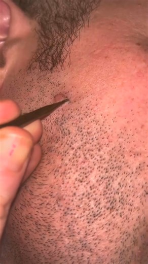 Removal my husband beard pili multigemini #multigemini #beardplucking | Jennifer M. Jane