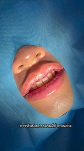 " Lip surgery without boundaries " 在这段简短的视频中，我们将快速介绍上下唇整形手术的关键步骤和注意事项。了解手术的过程、效果以及恢复期，让你在决定前有更全面的认识。无论你是对美丽的追求，还是希望改善唇部外形，这个视频都会为你提供有价值的信息。观看后，请不要忘记点赞和分享给朋友，让更多人了解唇部整形手术的真实情况！#唇部整形 #美容 #健康 #整形手术 #快速了解 ในวิดีโอสั้น ๆ นี้ เราจะแสดงขั้นตอนสำคัญการทำศัลยกรรมริมฝีปากบนและล่างอย่างรวดเร็ว ทำความเข้าใจกระบวนการผลกระทบ และระยะเวลาการกู้คืนของการดำเนินการ เพื่อให้คุณมีความเข้าใจที่ครอบคลุมมากขึ้น ก่อนตัดสินใจ ไม่ว่าคุณจะแสวงหาความงามหรือ ต้องการปรับปรุงรูปลักษณ์ของริมฝีปาก วิดีโอนี้จะให้ข้อมูลที่มีค่าแก่