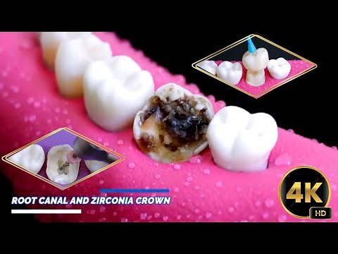 Root Canal & Crown Procedure: Restoring a Severely Decayed Tooth* rct treatment video/teeth cleaning