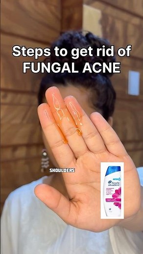Head and shoulders for acne! How to get rid of acne?