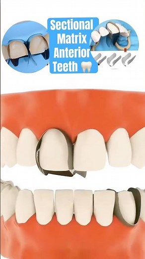 Sectional Matrix for Anterior Teeth Composite Build up