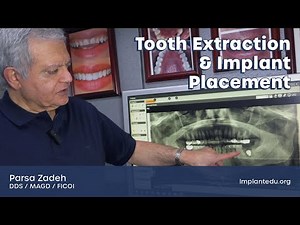 Same-Day Tooth Extraction & Implant: Step-by-Step (Full Video)