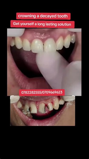 #Crowning grossly carious teeth#for long lasting smiles #kampala_uganda🇺🇬🇺🇬
