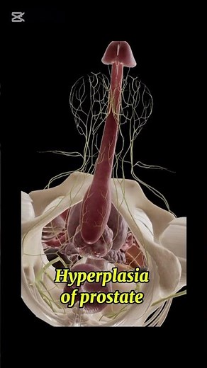 Hyperplasia of prostate gland#andrology#1millionviews#3danimation#viralvideo