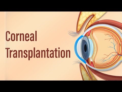 Corneal Transplantation