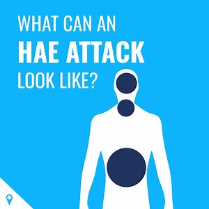 The symptoms of hereditary angioedema (HAE) can include attacks of swelling that can happen anywhere in the body. Some people experience a tingling sensation or a rash before an attack. Learn more about how an HAE attack occurs. | DiscoverHAE