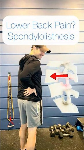 Spondylolisthesis Explained: Can a Vertebra Really Slip and Cause Back Pain?