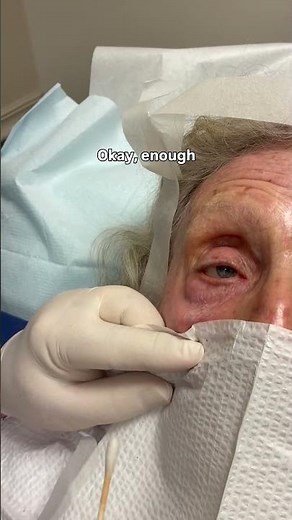 Dermatologist with 50 years of experience shows using TCA 50% peel under eyes (pt. 6)
