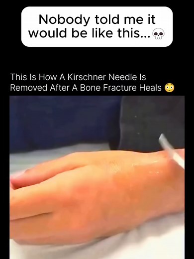 They just… YANKED it out. 😳 That metal pin you saw get pulled from that hand? That's a Kirschner wire — a K-wire — and it was literally holding a broken bone together from the inside. K-wires are thin surgical pins inserted through the skin directly into fractured bone fragments to hold everything in perfect alignment while your body heals itself. 🦴 And when the bone is ready? Doctors pull it out. Fast. Just like that. The wild part? In many cases it's done with just local anesthesia — no majo