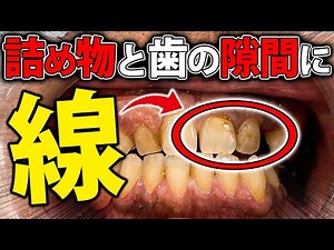 【詰め物 歯 変色】詰め物と歯の隙間に茶色い線が！それ、詰め物縮んでいます