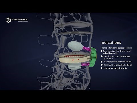 OLIF Surgery Procedure Video with Double Medical Oblique Lateral Intervertebral Fusion Cage System