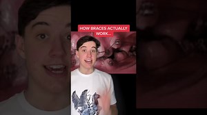 How braces exert pressure to reshape teeth over time