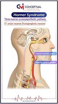 🔍 Horner Syndrome (HS) Animated Quick Review