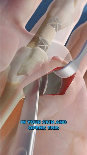 Trigger Finger Release (3D Animation)