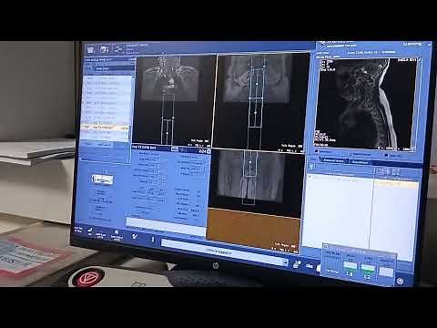 HOW TO DO MRI whole spine screening