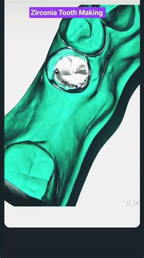 Exocad #orthodontist #smiledesigndental #dentalartistry #teethcleaning #unboxing