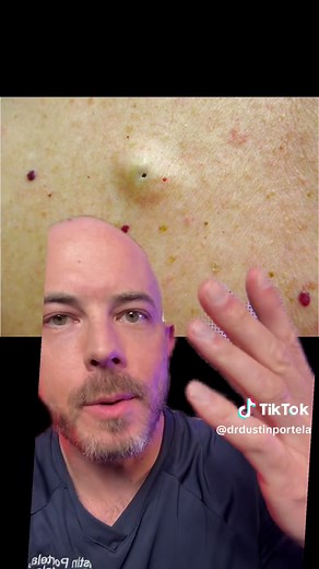 What is a cyst? What do they look like on ultrasound and under the microscope? #creatorsearchinsights #cyst #cystpop #greenscreen