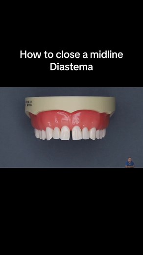 Closing a Midline Diastema with Composite: Step-by-Step Guide