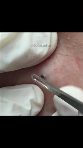 This Week's Extractions