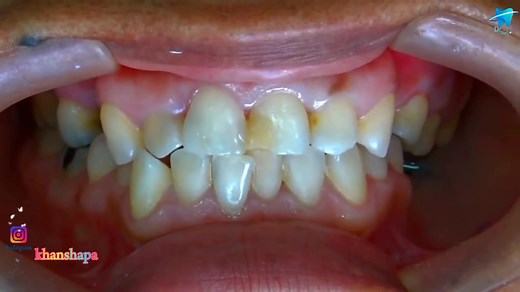 Tooth Cavity Reconstruction: Fixing Cavities | Dr. Safiu