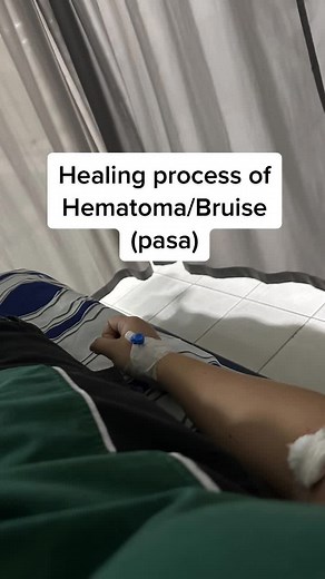 Healing Process of Hematoma/Bruise: Understanding Colors and Stages of Healing