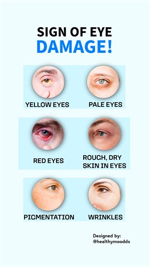 "Warning Signs Your Eyes Are in Trouble! 👁️🚨" #healthylife #eyeshealth