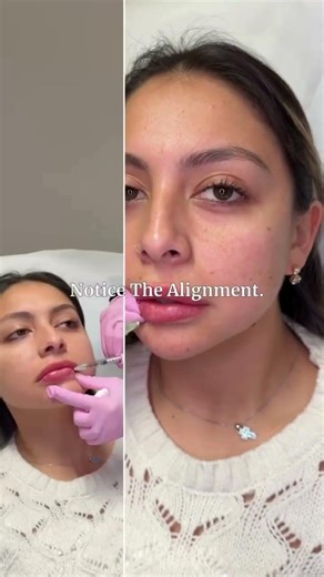 Chin + Lip Filler for Facial Balance | Subtle Structural Enhancement at DermDuo