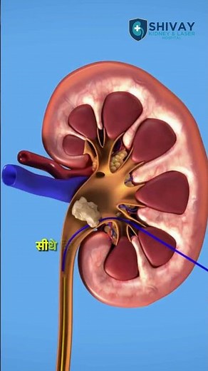 Dealing with a 20mm kidney stone? Here is the truth about your treatment options.
