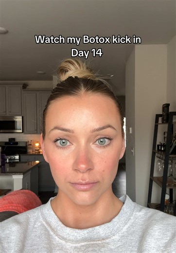 First timer here! Only 26 units between my forehead/11s bc I didn’t want to be totally frozen. So happy with how it turned out! Thanks to @caseycooperaesthetics #medspa #skincare #fyp #glowup