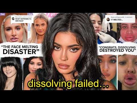 DISSOLVING YOUR FILLERS DESTROYED YOUR FACE (scientifically proven)