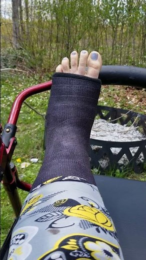 My Middle Toe Is Apparently a Dancer: Twitching Toes In My Foot Cast