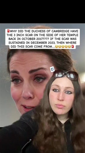 Mystery of Kate Middleton's 3-Inch Scar Explained