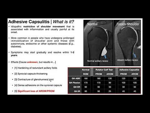 Adhesive Capsulitis (Frozen Shoulder) | Part 1 - Presentation & Pathophysiology