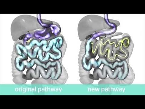 Loop Duodenal Switch Info Video